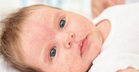 As principais causas de alergia na pele do Bebê
