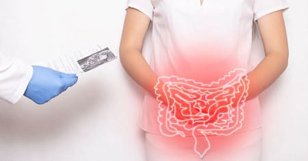 O que é obstrução intestinal? Tudo o que você precisa saber!