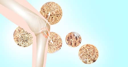 O que é Osteoporose? Tudo o que você precisa saber!