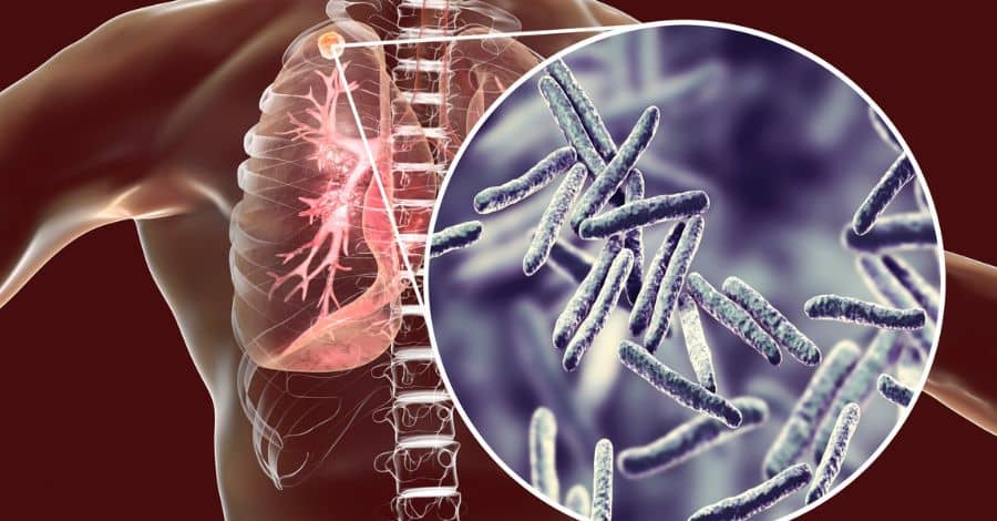 4 Tipos de tuberculose: Tudo o que você precisa saber!
